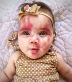 Baby With Red Birthmark Called ‘Hideous’ And ‘Defective’, But Wait Till You See This Beautiful Kid Now