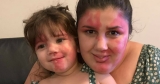 Mom paints face to look like daughter’s heart-shaped port wine birthmark