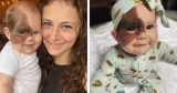 Mom on a mission to show daughter with extremely rare birthmark that she is beautiful